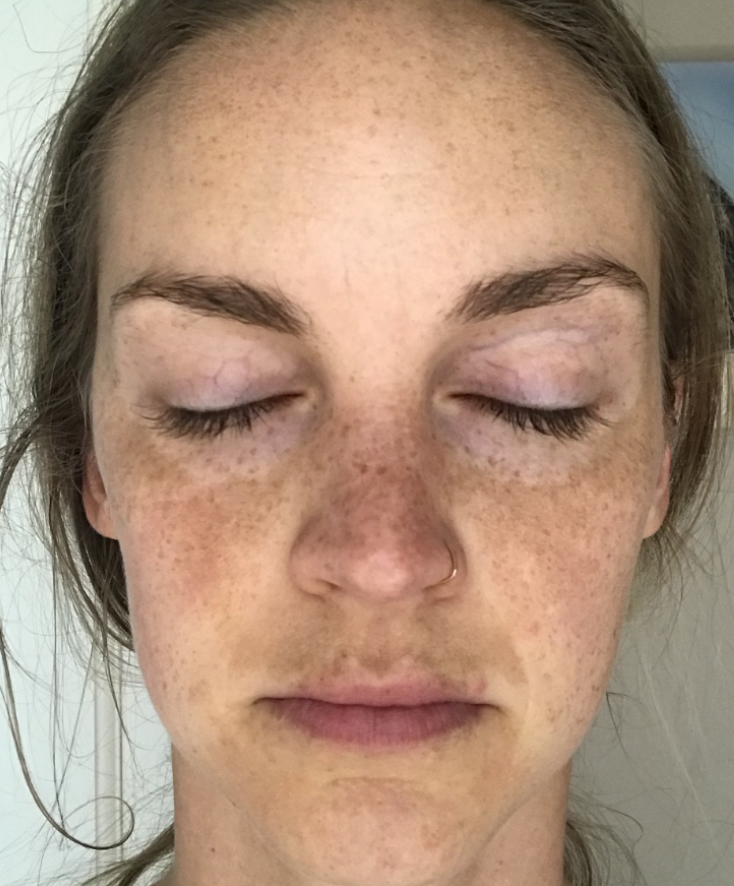 i healed my melasma with MORE SUN, not less.
