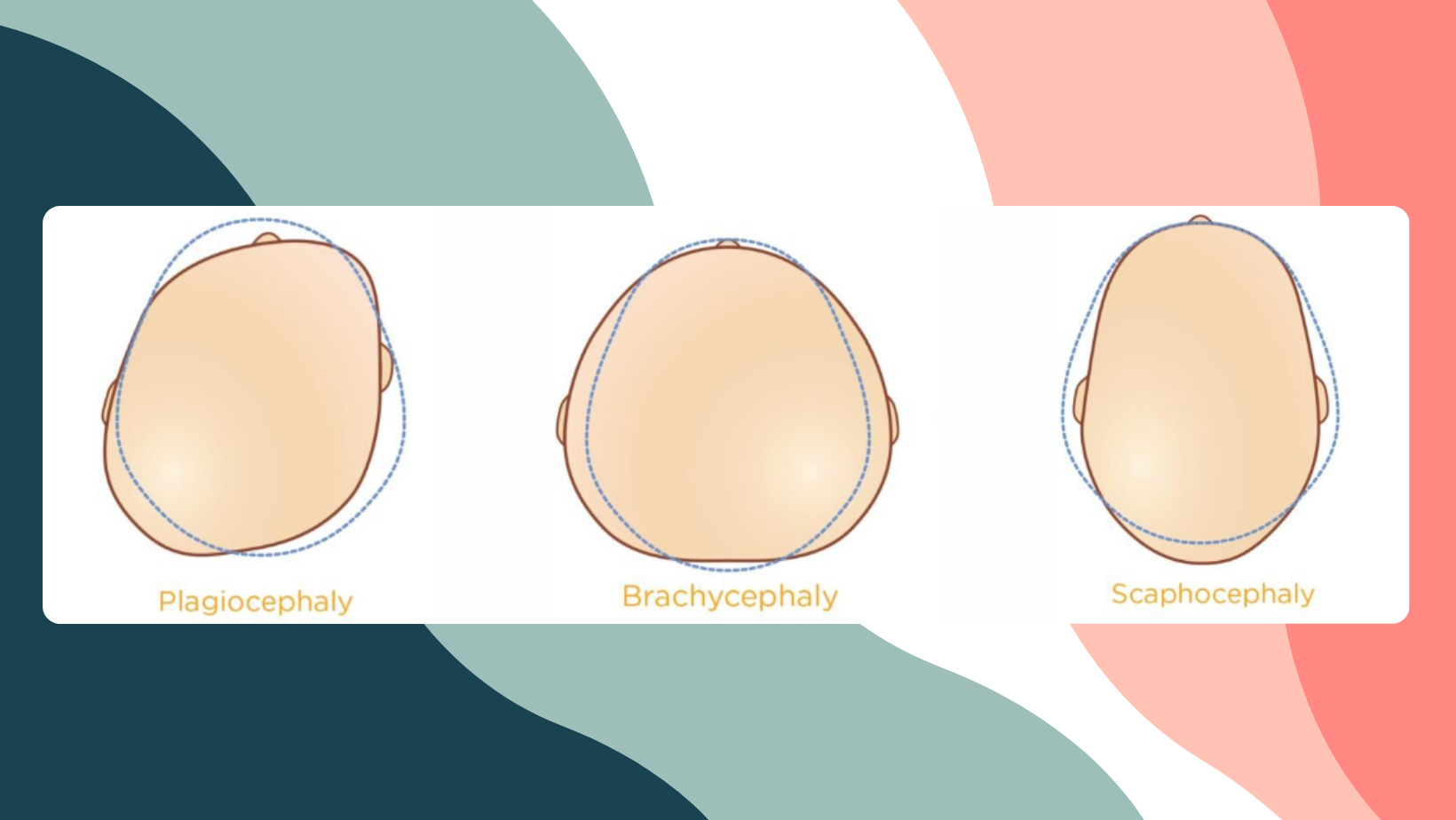 Head Shapes Month Old Flat Head Normal Baby Head Shape Flat On One