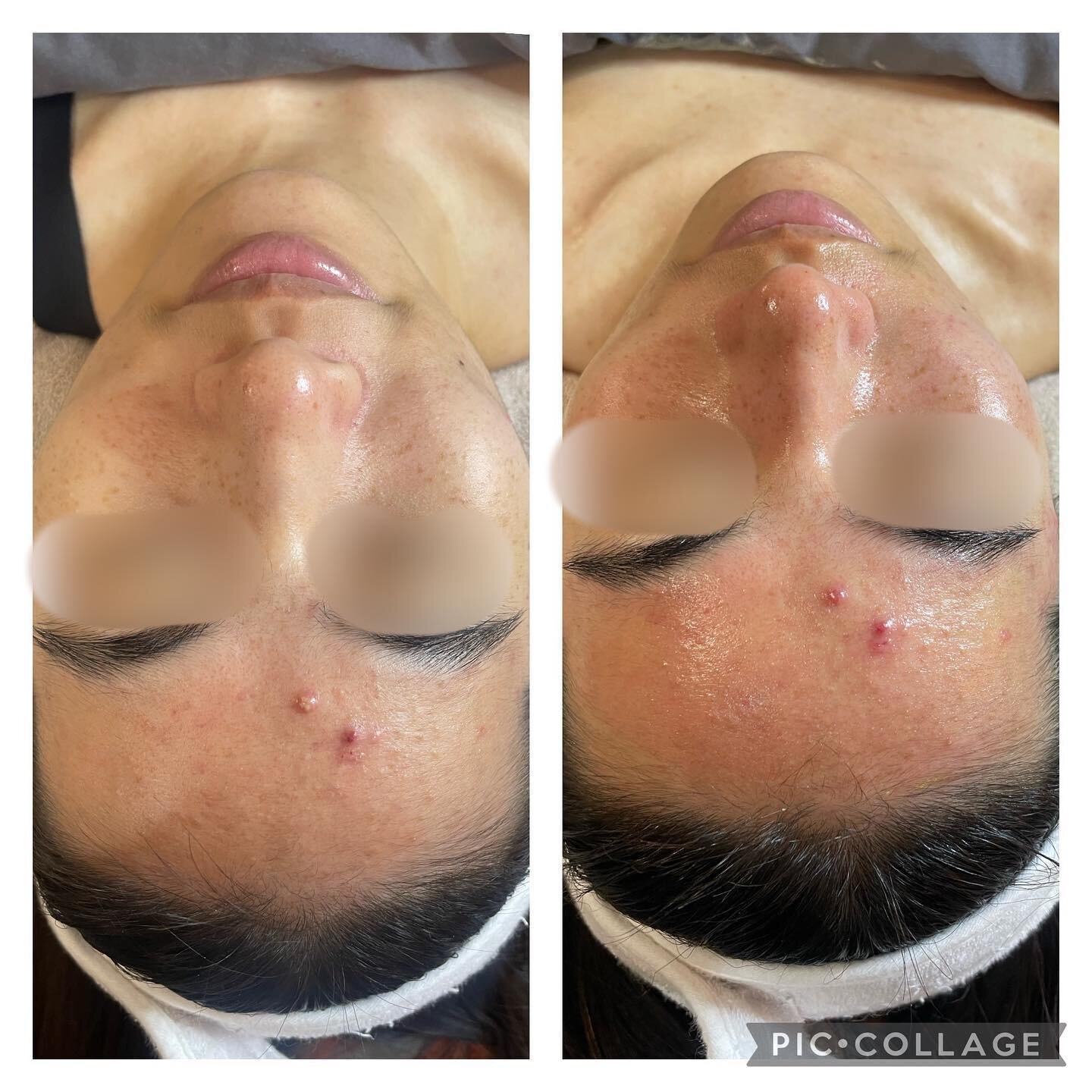 Oxygenating facial before &amp; after! Skin is looking so much more refreshed and vibrant! 🤍💙 @elementalsskincare @skinmoderne #elementals #facial #oxygenating