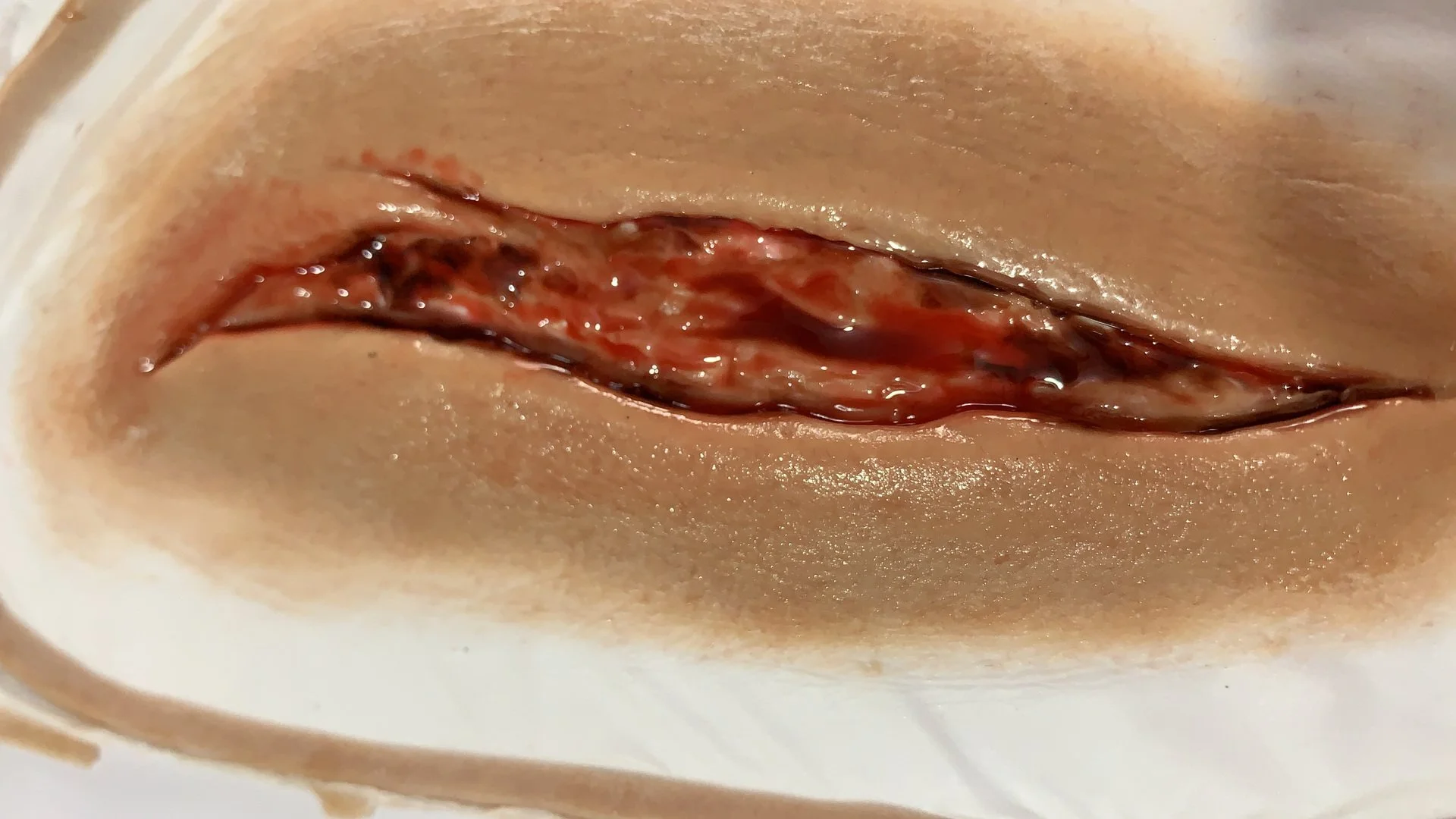 Close-up of a wound or surgical incision on human skin with visible tissue and blood.