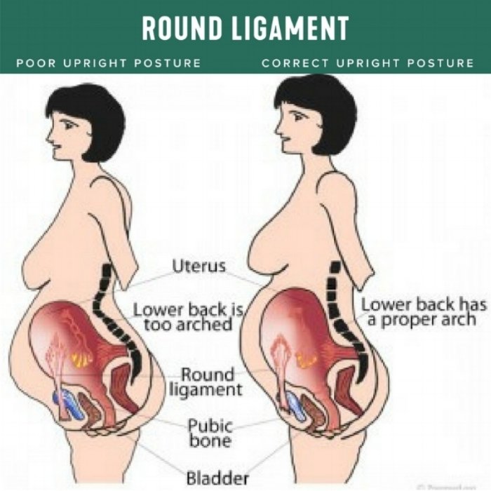 Round ligament pain in pregnancy