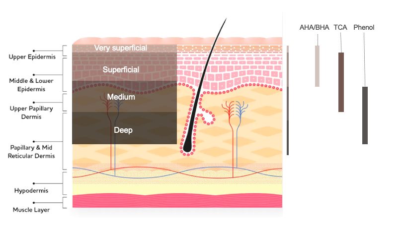physician deep phenol chemical peel Aventura FL