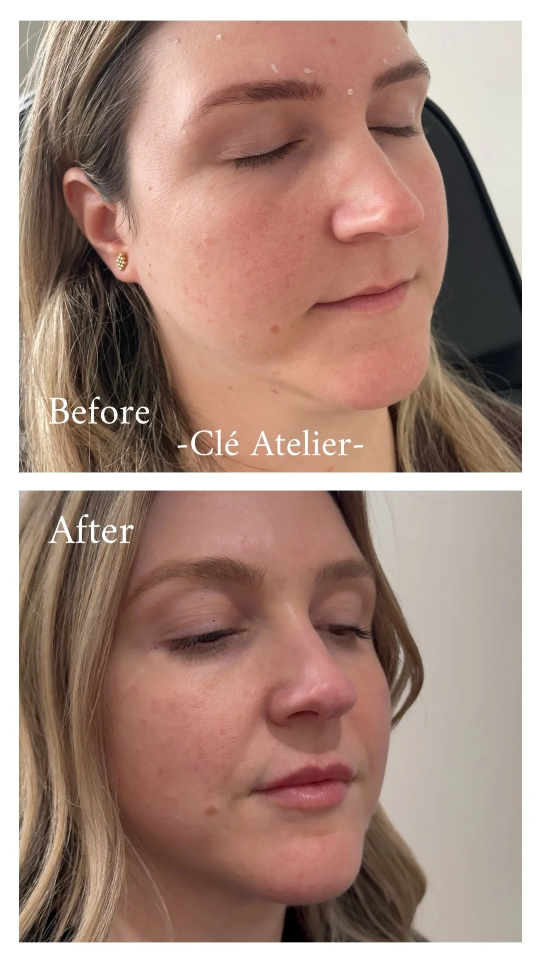 Before and after photos showing a woman's face, with improvements in skin texture and appearance after a treatment, labeled 'Clé Atelier'.