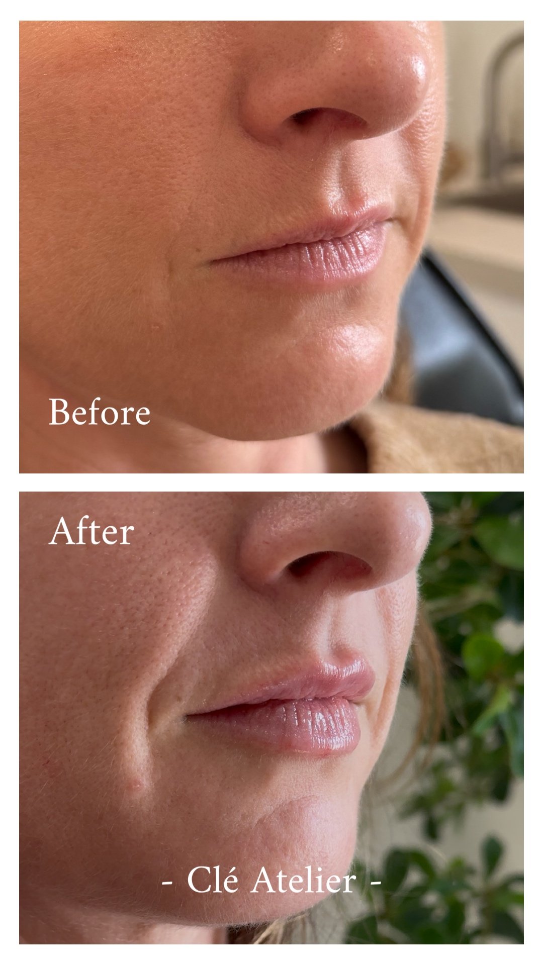 Close-up comparison of a woman's nose and lips before and after skincare treatment, showing clearer, smoother skin.