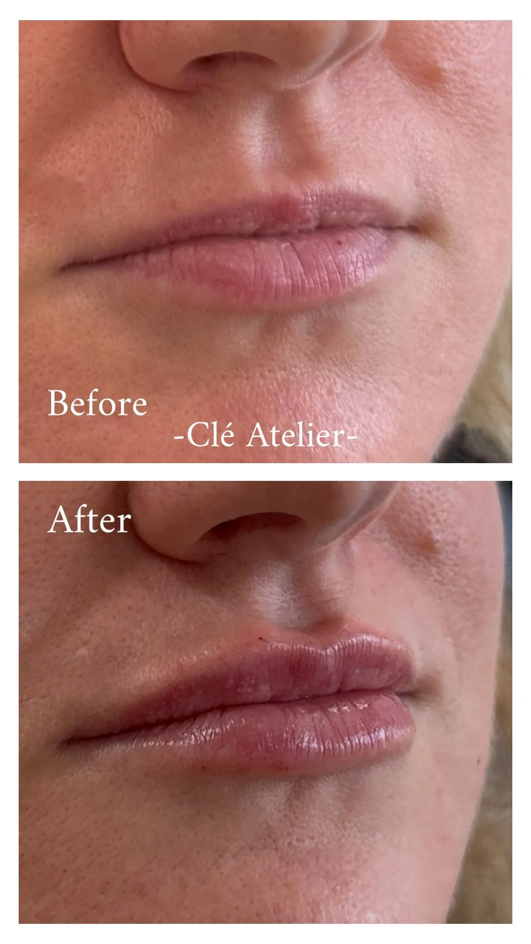 Close-up of a person's lips before and after cosmetic treatment, with the before image showing lips with dry skin and uneven texture, and the after image showing smoother, fuller lips.