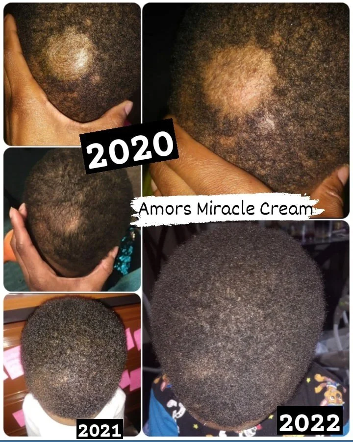 Teana Capitis Infection results in hair lose using only Amor's Miraacle Cream and Mask.