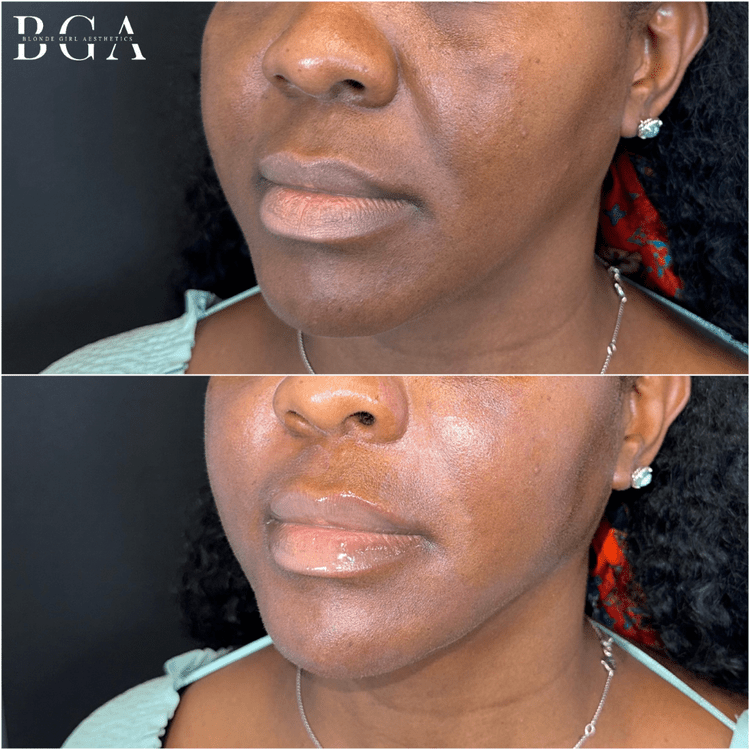 Full facial balancing with dermal filler and Sculptra, before and after, by Dr. Alex, DNP