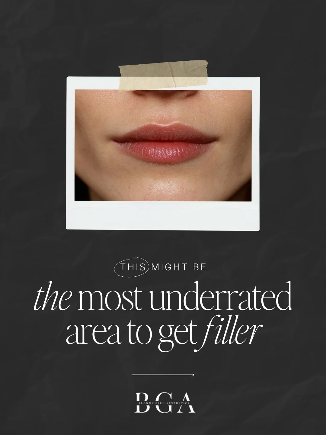 ✨We&rsquo;re back, and 2026 is all about 𝐬𝐮𝐛𝐭𝐥𝐞, 𝐥𝐮𝐱𝐞 𝐮𝐩𝐠𝐫𝐚𝐝𝐞𝐬! 💖

Let&rsquo;s talk about one of the most underrated aesthetic tweaks: 𝐩𝐞𝐫𝐢𝐨𝐫𝐚𝐥 𝐟𝐢𝐥𝐥𝐞𝐫. 💉

Not lip filler&mdash;think of it as the 𝐬𝐮𝐩𝐩𝐨𝐫𝐭 𝐬𝐲𝐬