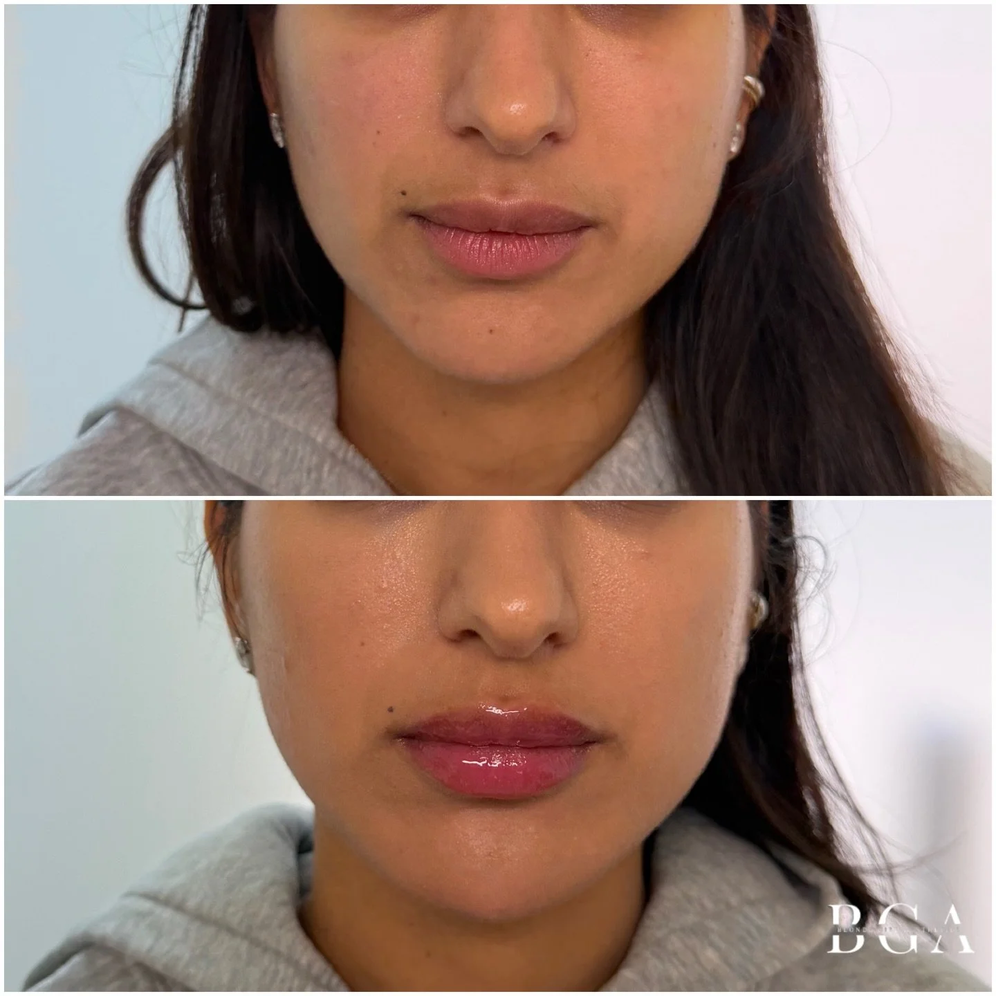 When that lower face refresh hits 𝒋𝒖𝒔𝒕 𝒓𝒊𝒈𝒉𝒕 ✨💉

This patient came in saying what 𝐰𝐞 𝐡𝐞𝐚𝐫 𝐬𝐨 𝐨𝐟𝐭𝐞𝐧:
&ldquo;Everyone I see with chin filler looks puffy or witchy &mdash; I don&rsquo;t want that.&rdquo;

Through 𝐭𝐫𝐮𝐬𝐭, 𝐞𝐝?