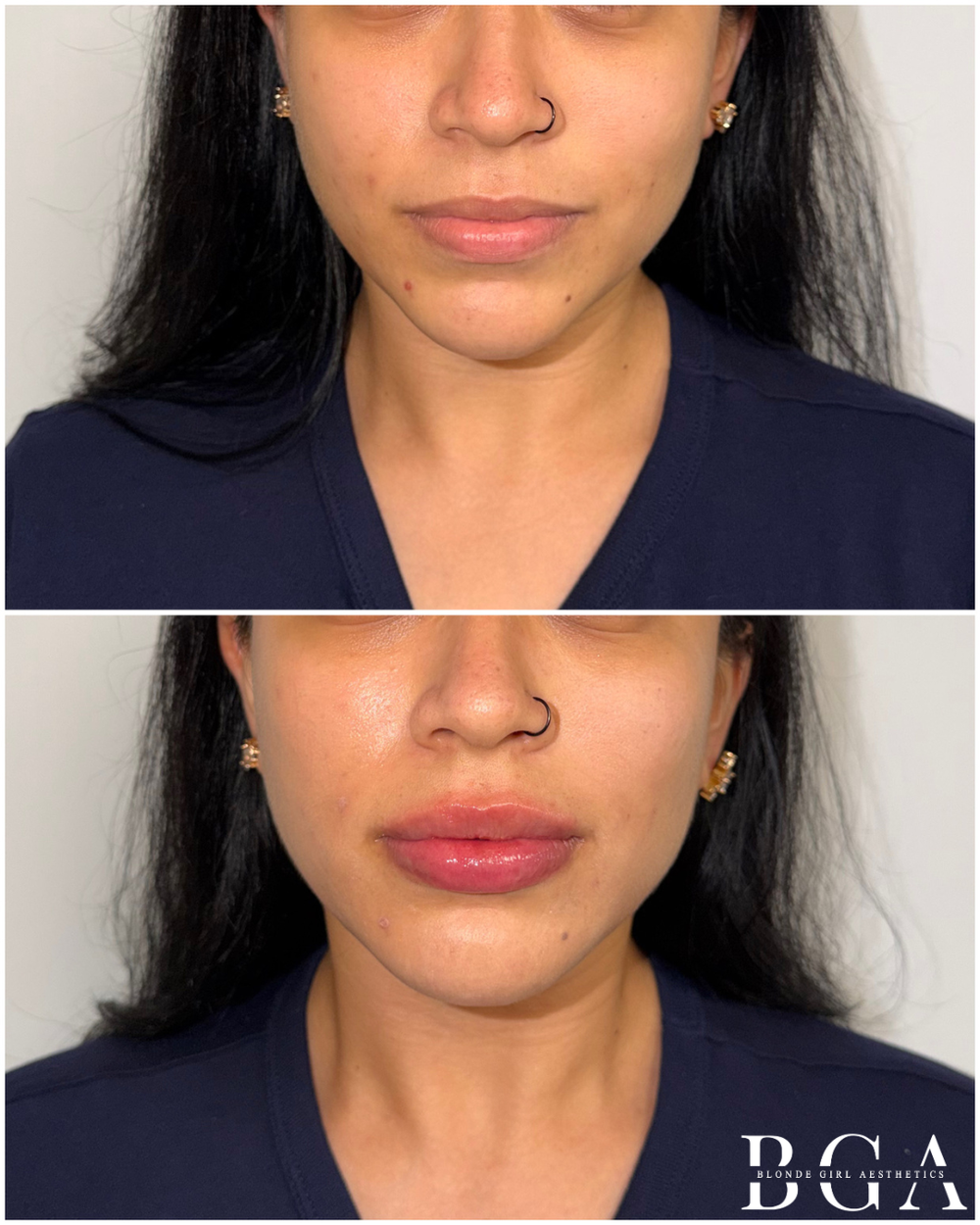 Before and after lip filler by Dr. Alex, DNP, at Blonde Girl Aesthetics: fuller, softly defined lips with a natural shape
