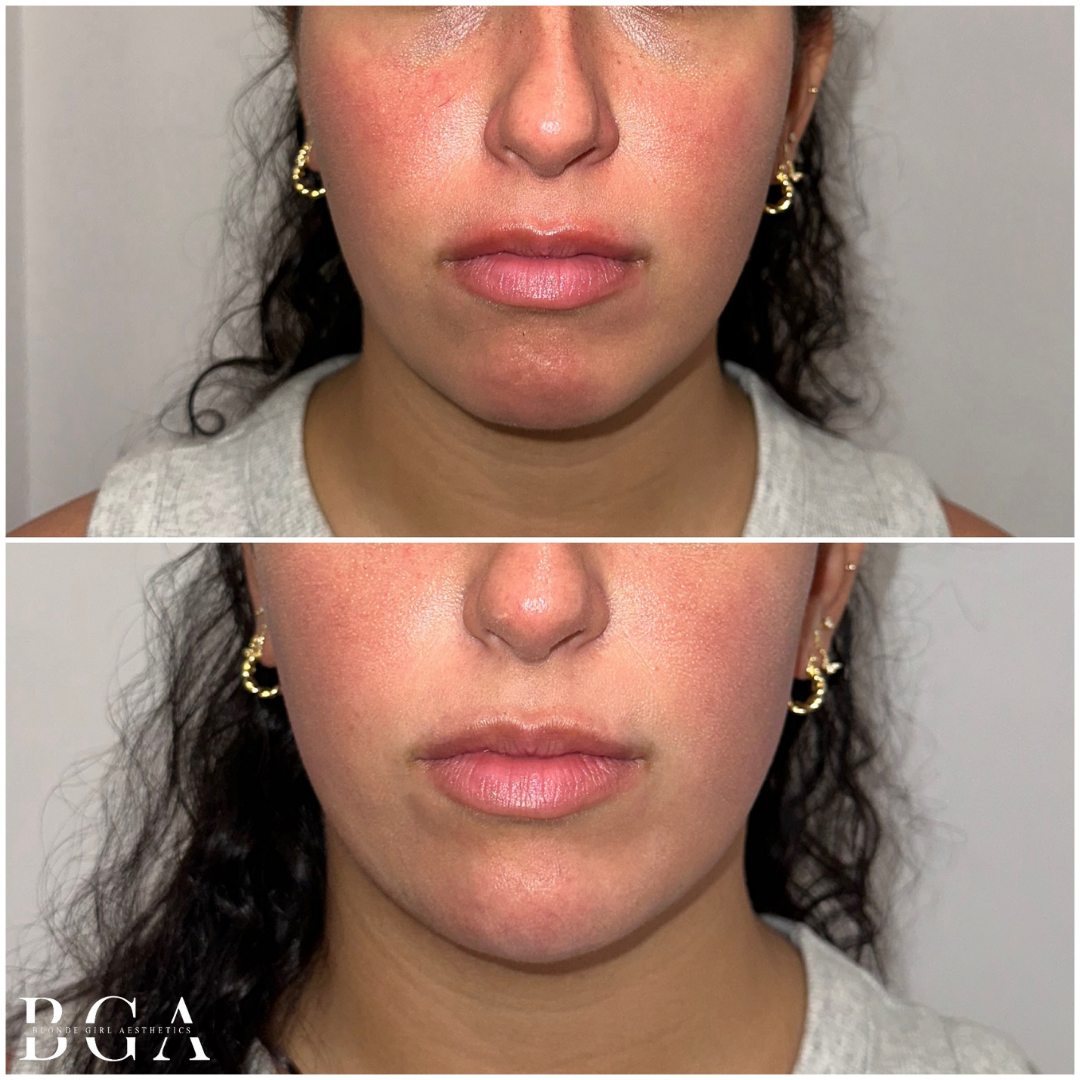 Chin Correction With Dermal Filler; Lower Face Dysport Treatment; Acne Protocol; Revision Skincare Regimen