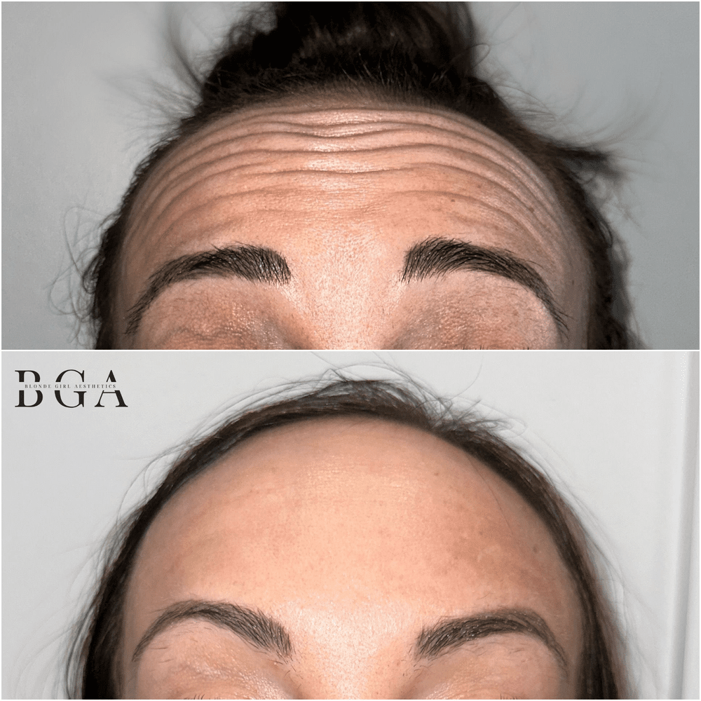 Before and after Botox to the forehead: horizontal forehead lines visibly softened, treated by Blonde Girl Aesthetics