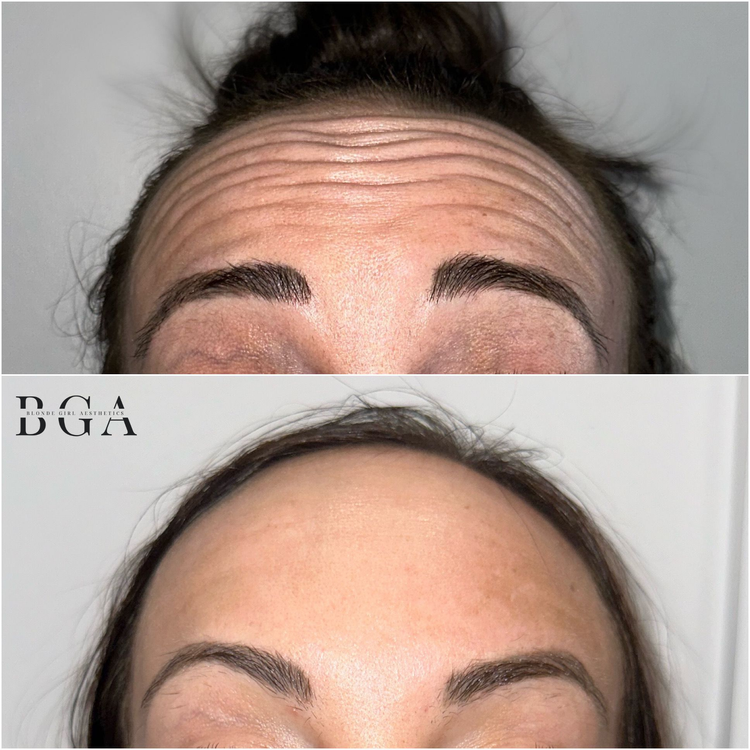 Before and after Botox to the forehead: horizontal forehead lines visibly softened, treated by Blonde Girl Aesthetics