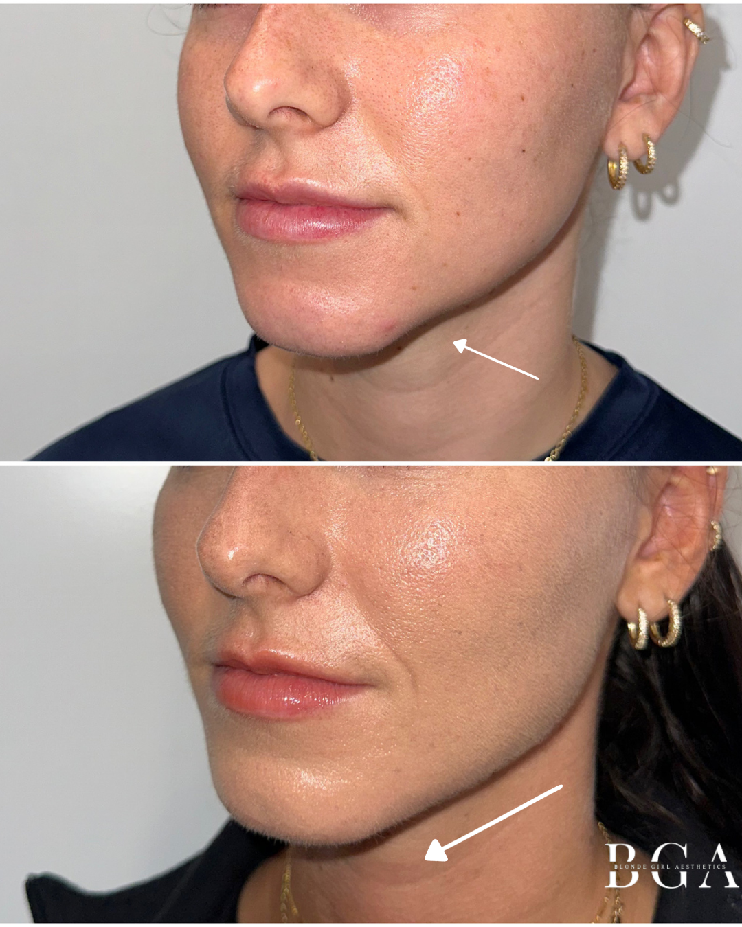 Chin, Jaw Line and Marionette Line Correction With Dermal Filler; Lower Face Dysport Treatment; Acne Protocol; Revision Skincare Regimen