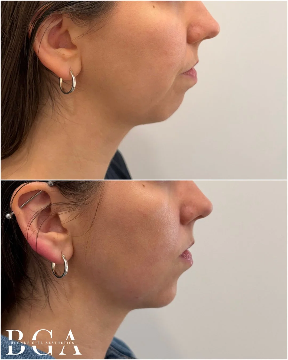 Before and after, in profile: the chin and jawline of a Blonde Girl Aesthetics patient