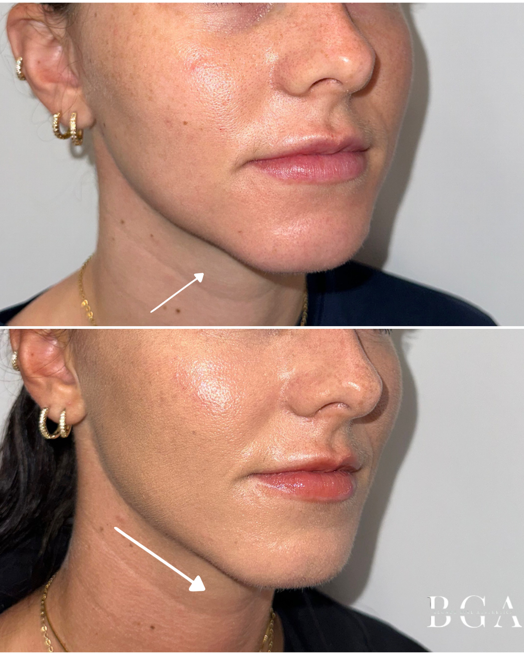 Chin, Jaw Line and Marionette Line Correction With Dermal Filler; Lower Face Dysport Treatment; Acne Protocol; Revision Skincare Regimen