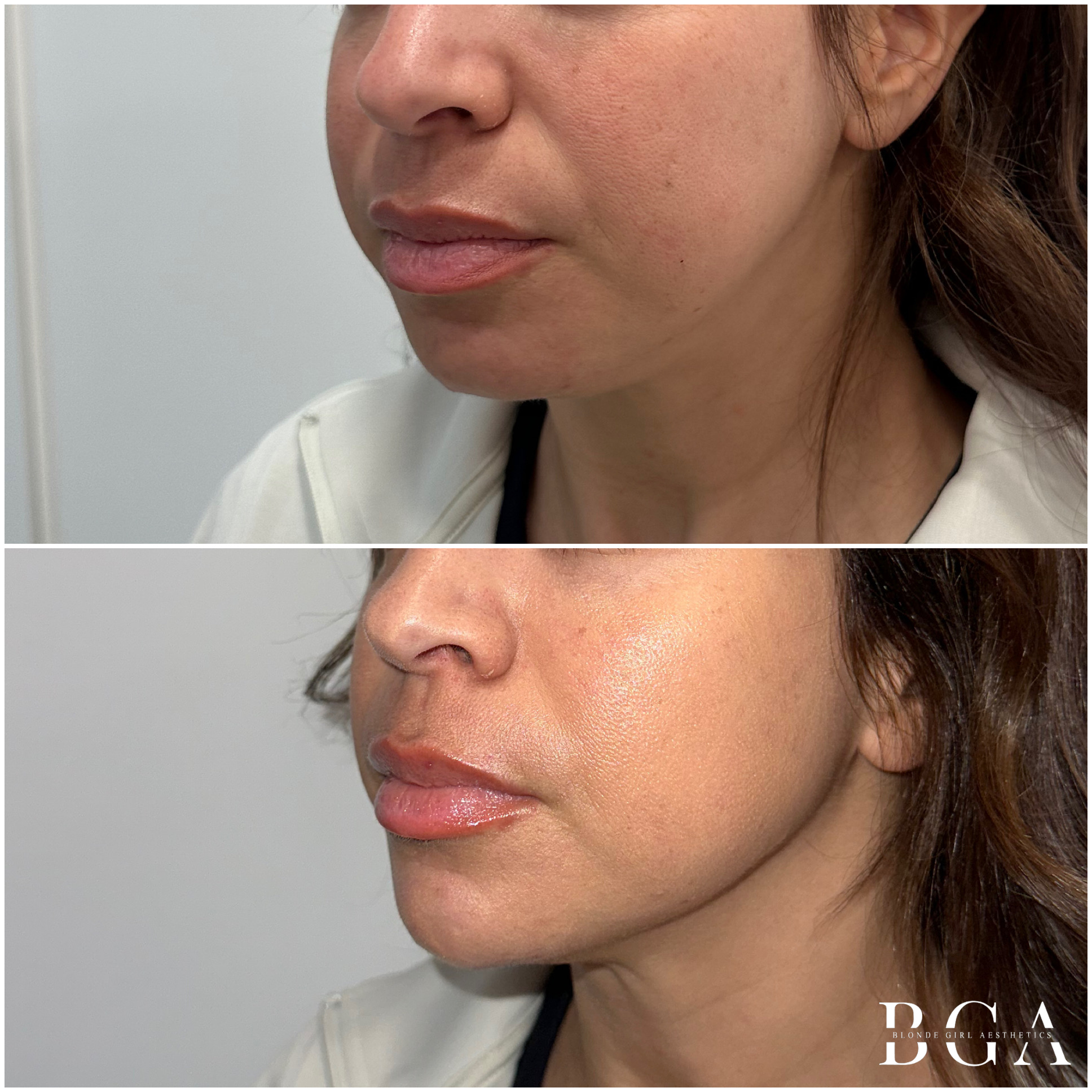 Full Facial Balancing with Dermal Fillers and Sculptra; Full Face Dysport Treatment; Treatment of Nasal Labial Folds, Marionette Lines, Lips, and Chin with Dermal Filler; Melasma Protocol; Microneedling Series;  Acne Protocol; Revision Skincare Regim