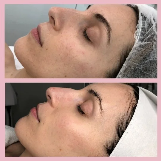 Scarring Before & After | Miranda, NSW