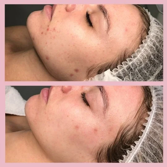 Acne Facial Sydney