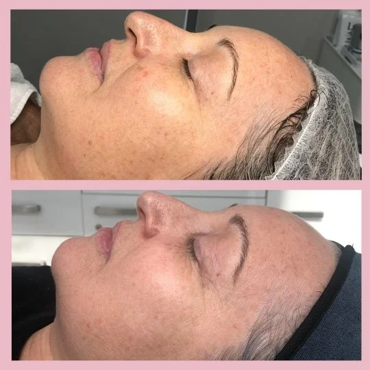 Pigmentation Removal - Before & After