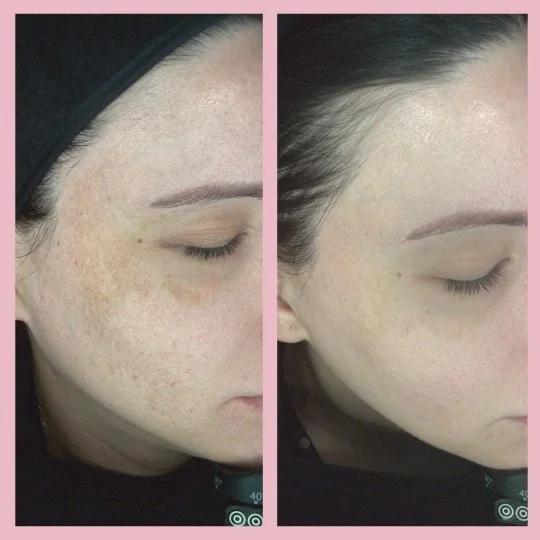 Hyperpigmentation Treatment Results - Before & After