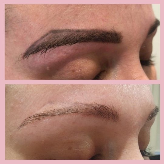 eyebrow-tattoo-removal-results.jpg