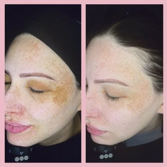 Face Hyperpigmentation Before & After