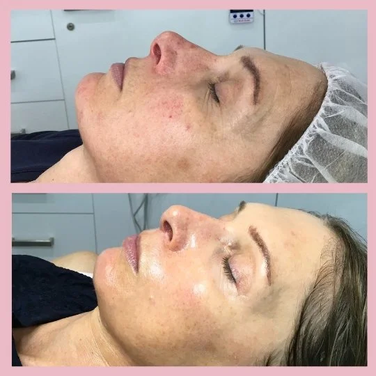 Anti Ageing Treatment Before & After