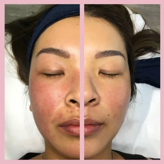 Rosacea Before & After