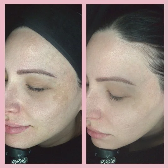 Remove Hyperpigmentation on Face - Before & After