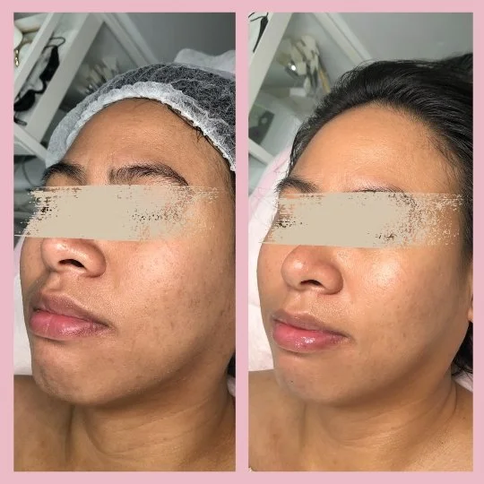 Biosonic Facial Before & After