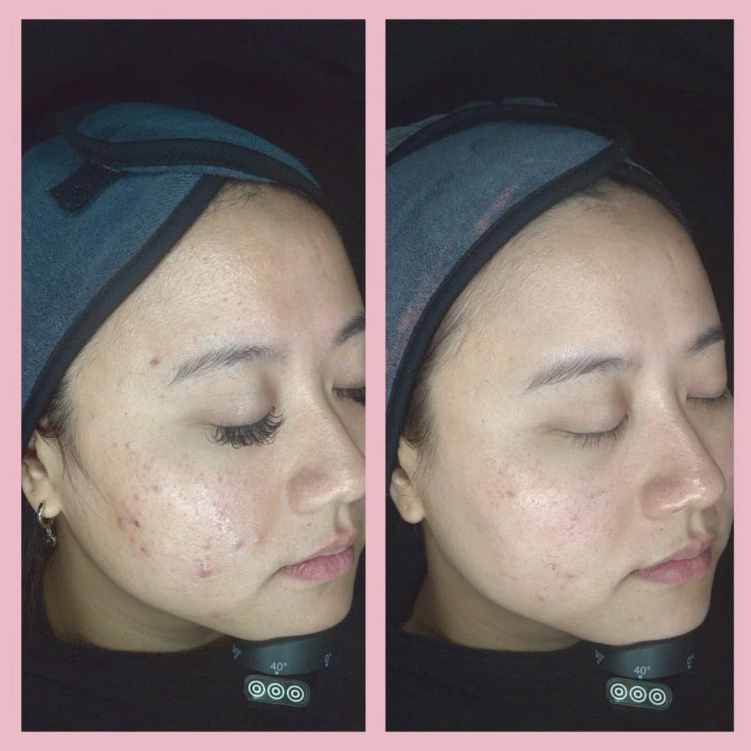 Acne Treatment Before & After