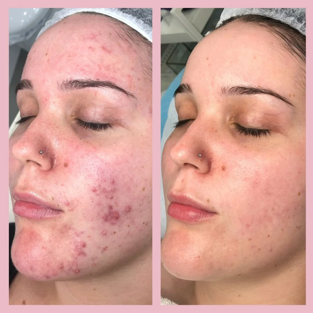 Acne & Congested Skin - Before & After