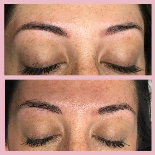 cosmetic-eyebrow-tattoo-removal-nsw.jpg