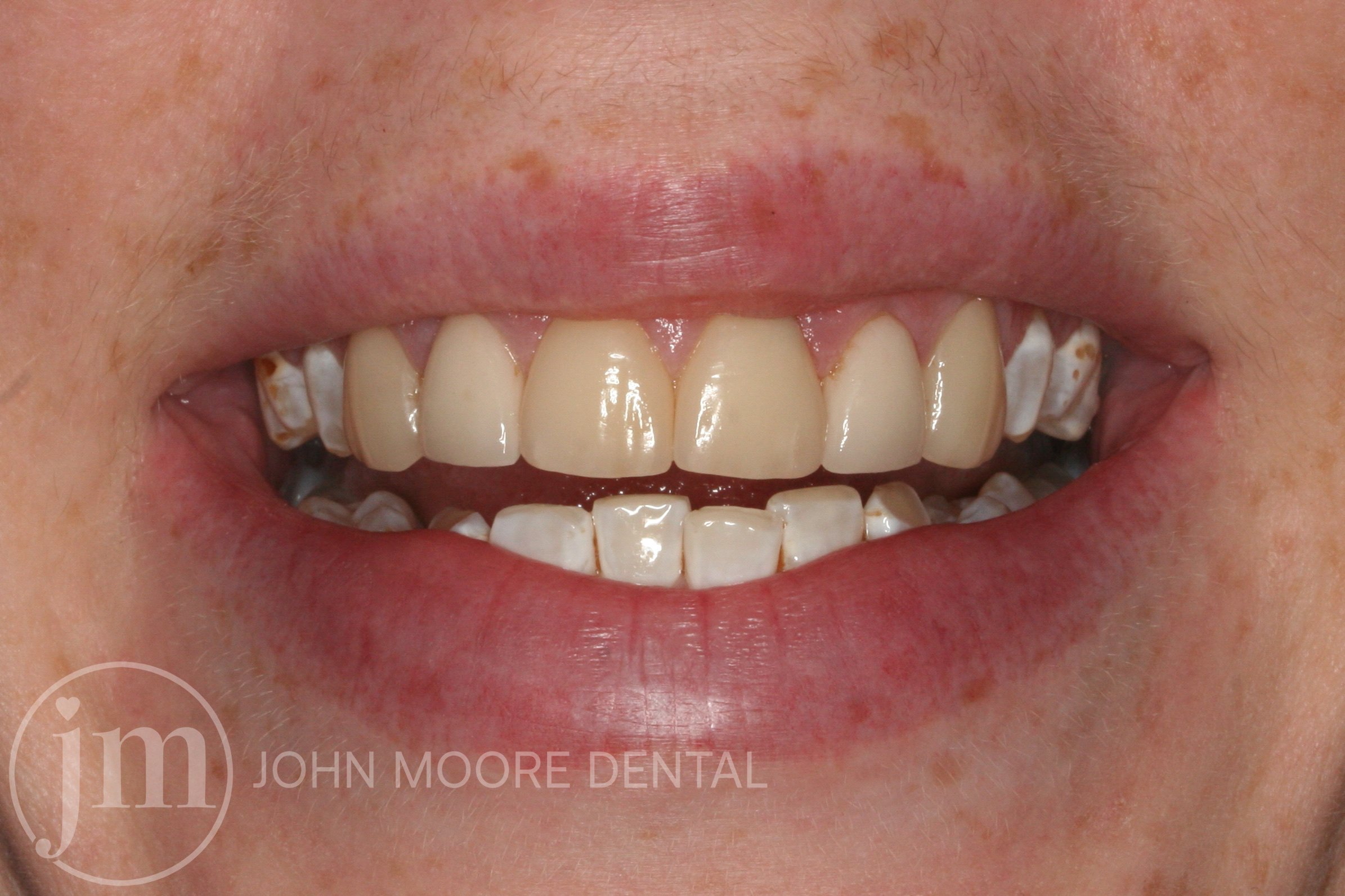 Natural Veneers Helen Before.jpg