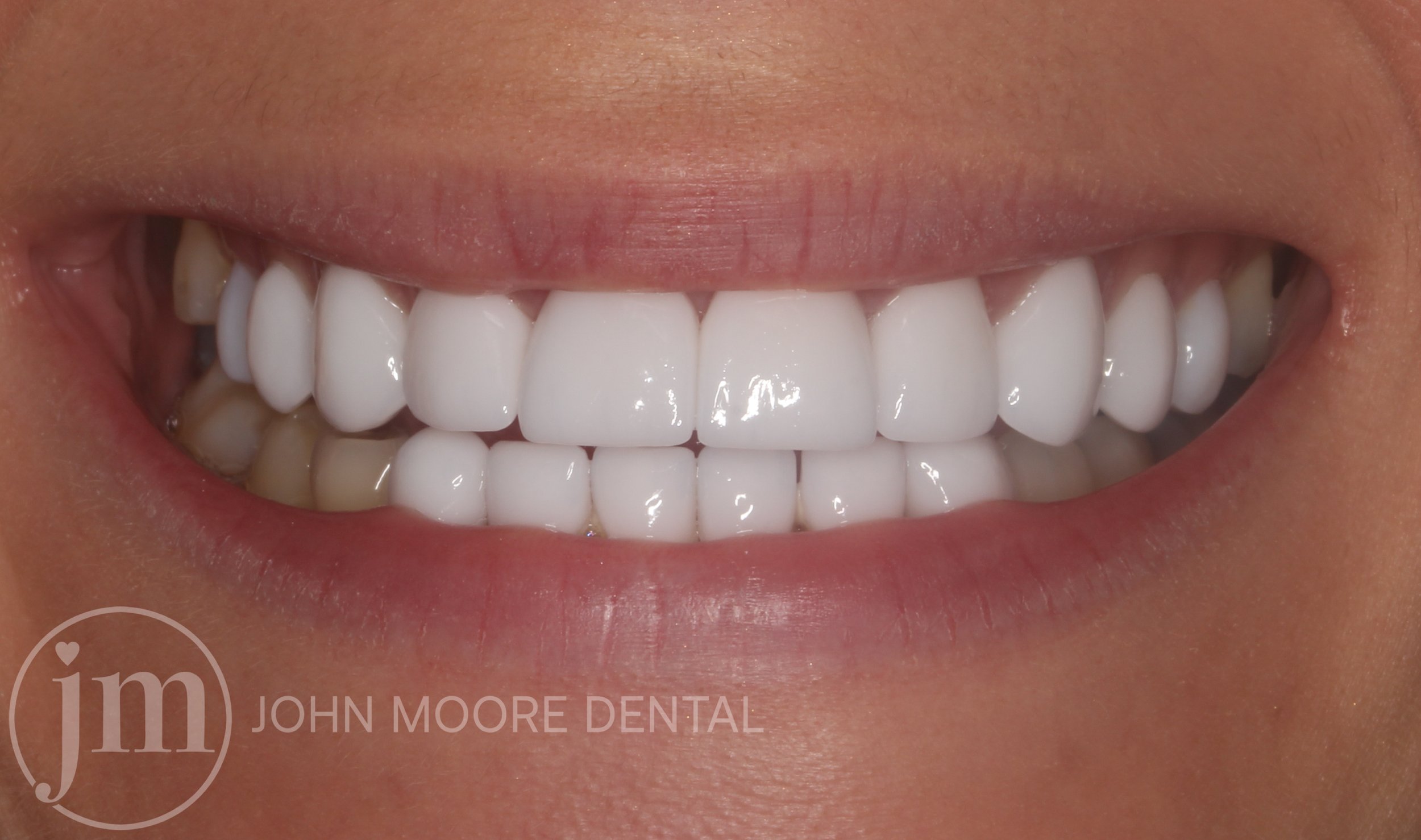 White Veneers.jpg