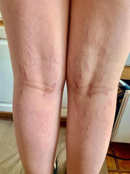 What is Bartonella - Lyme Disease Symptoms | Lyme Warrior | Lyme Warrior.