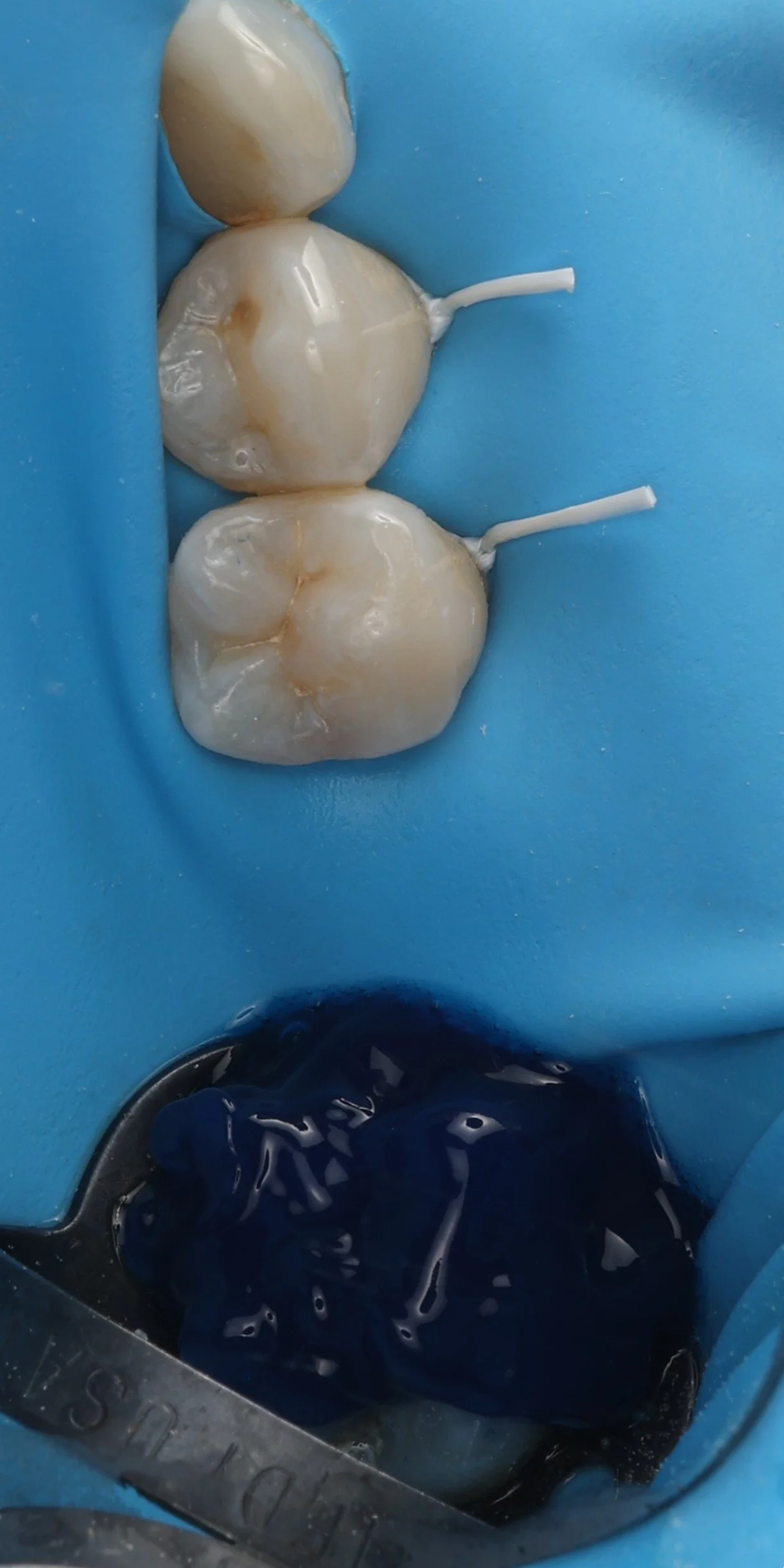 11 - Etching Amélaire.JPG