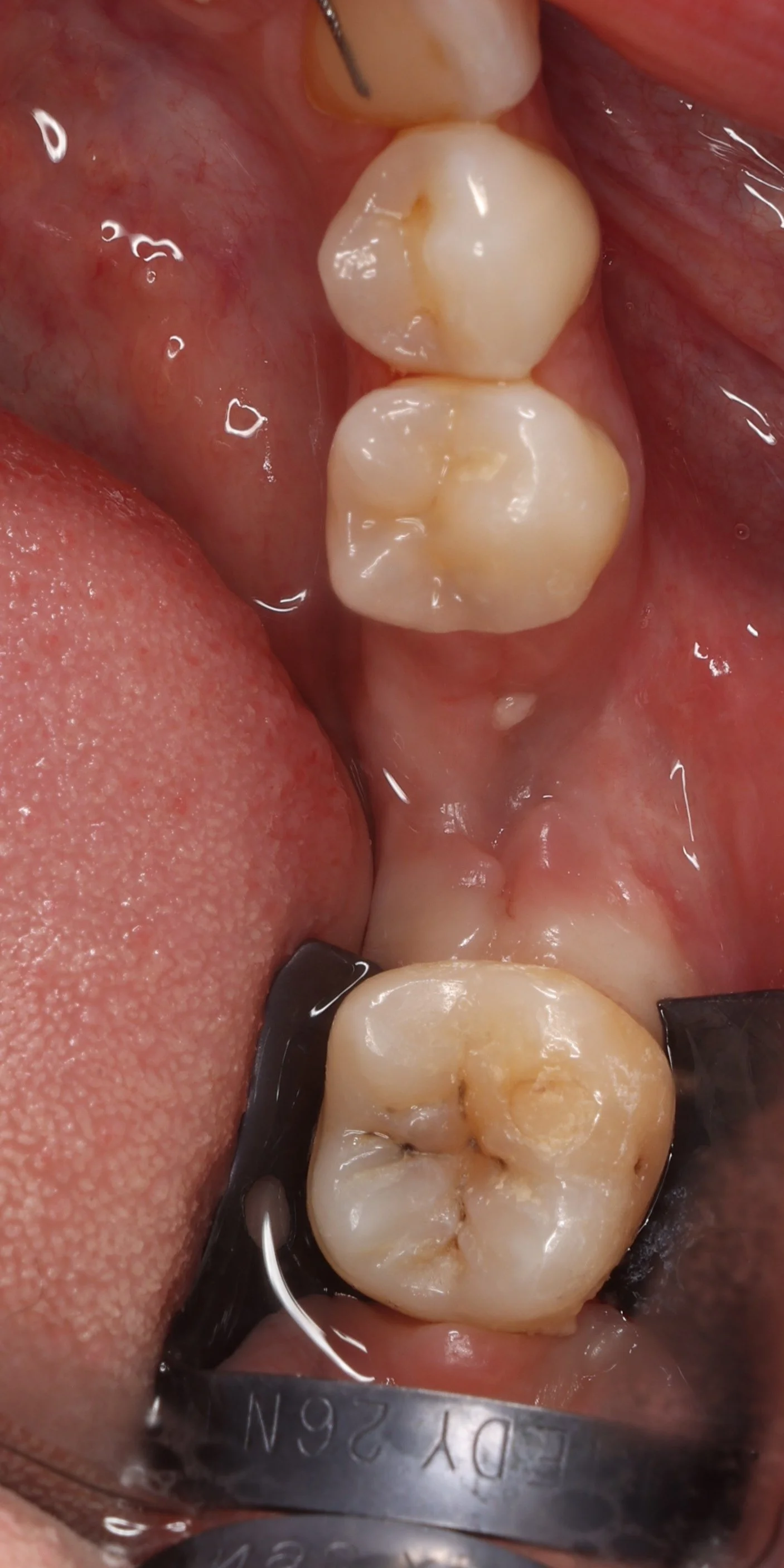 3 - Situation avant prep.JPG