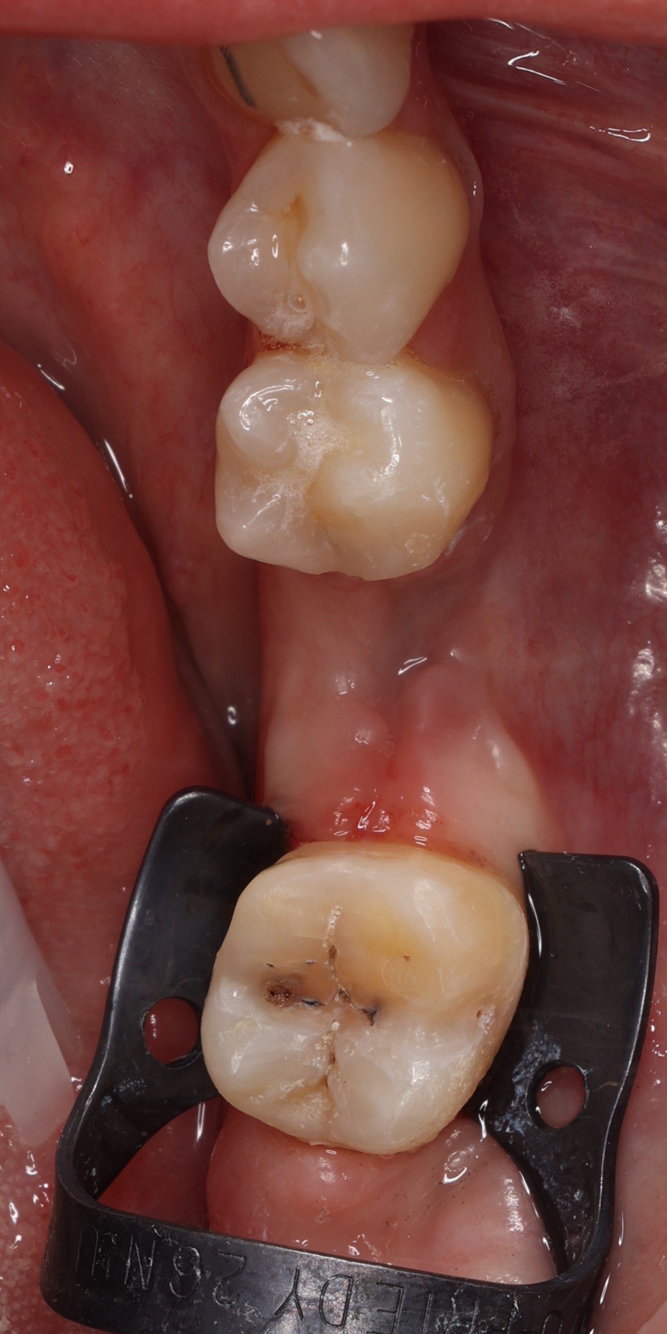 3 - Situation après prep non etch.JPG