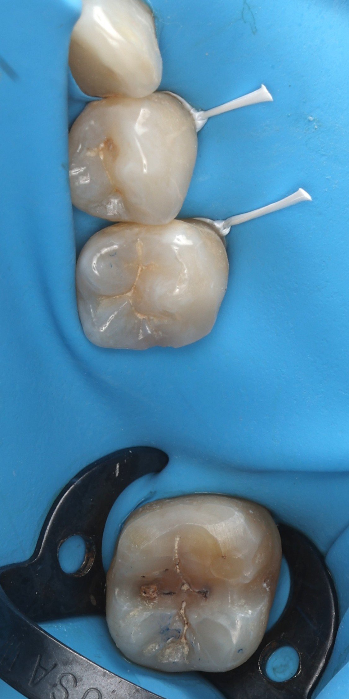 10 - Mise en place du champ opératoire.JPG