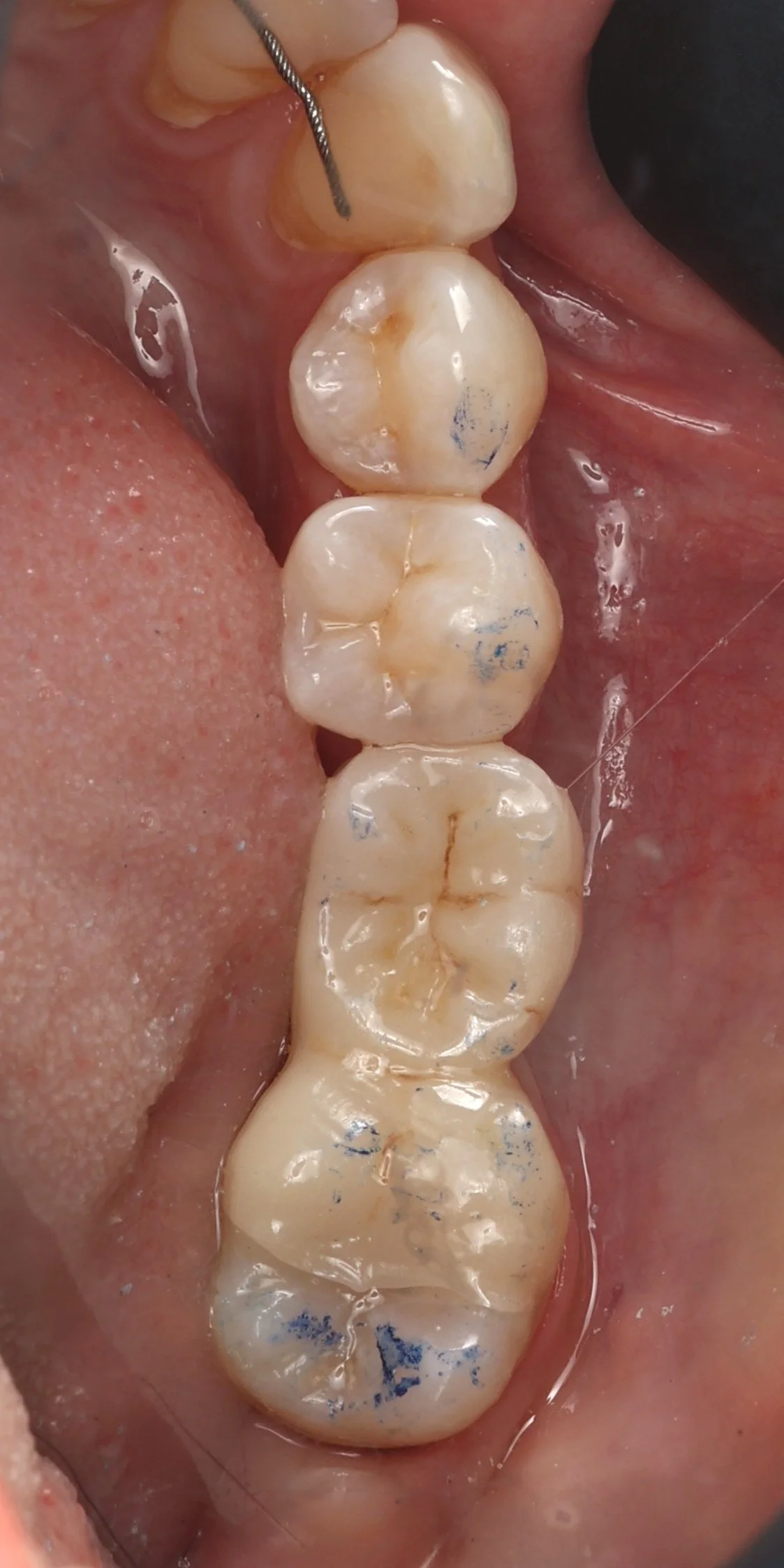 14 - Occlusion réglée.JPG