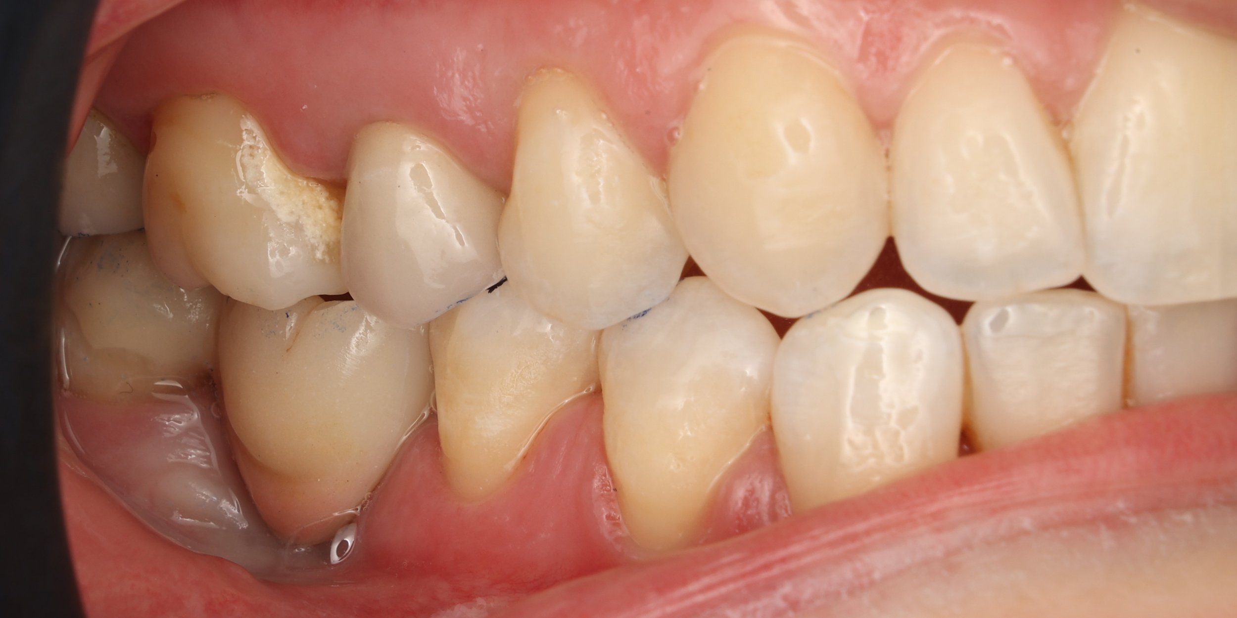 15 - Resultat esthétique V.JPG