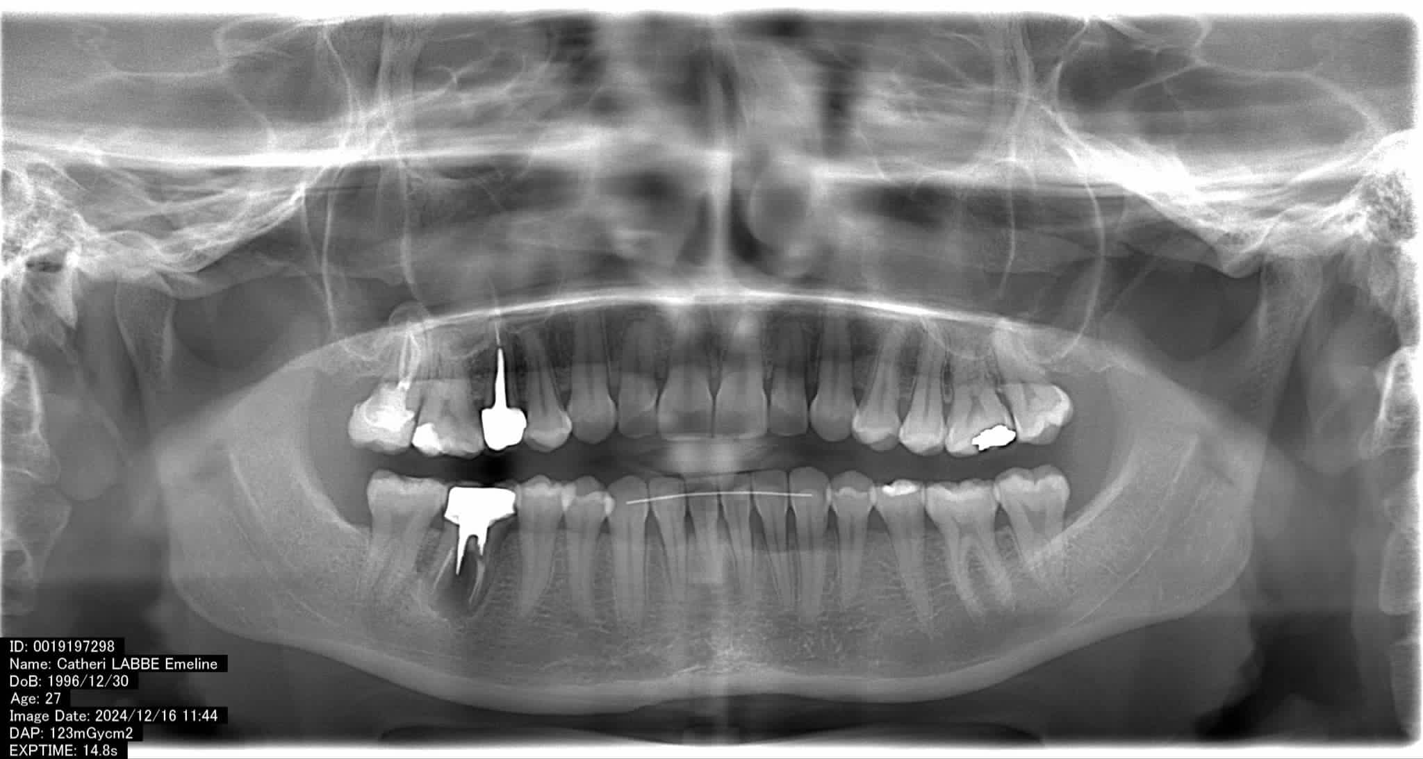 0 - Situation Initiale pré extraction.png