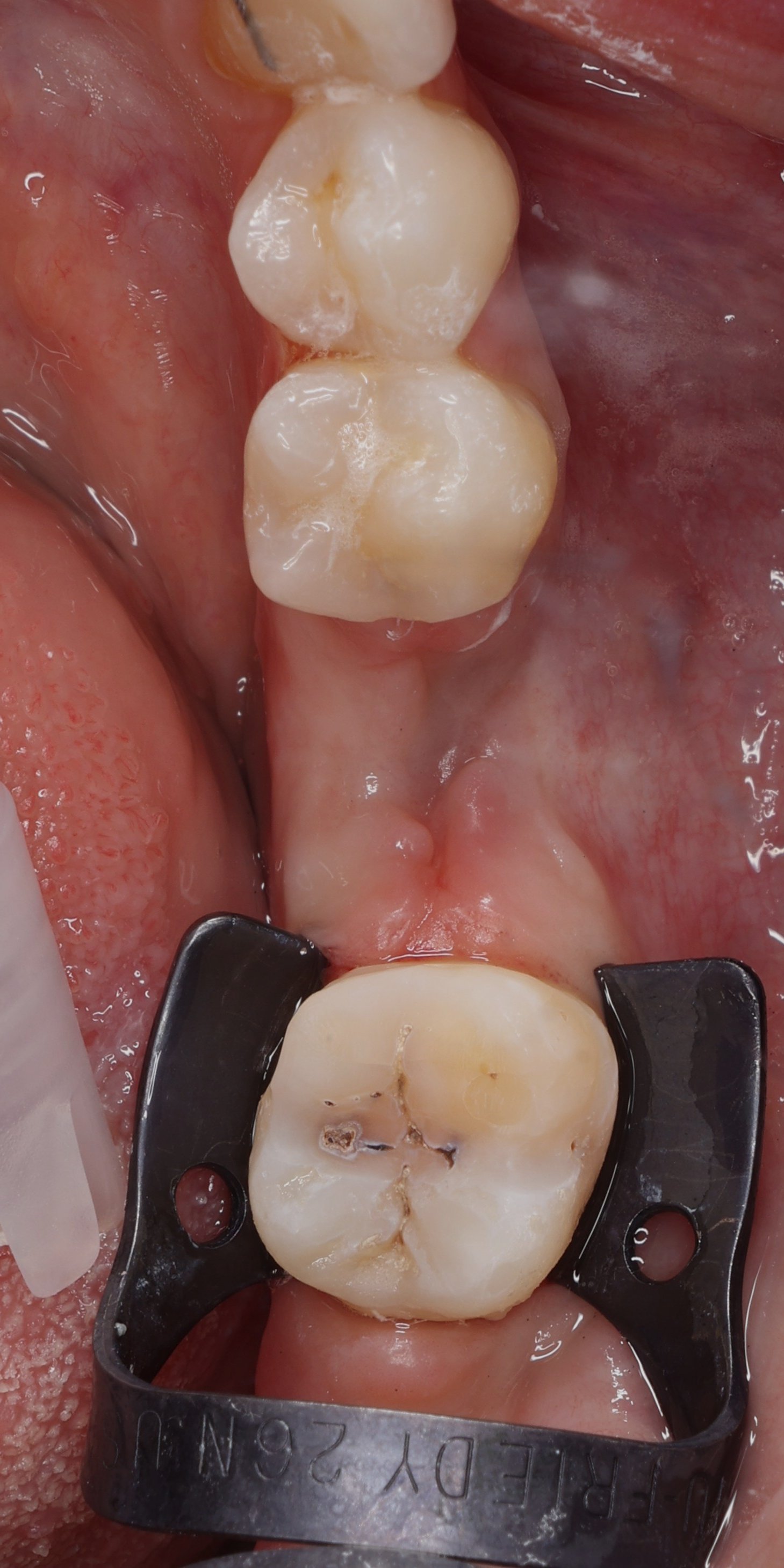 3 - Situation après prep etch.JPG