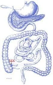 Could this be you? Ileocecal Valve (ICV) Syndrome