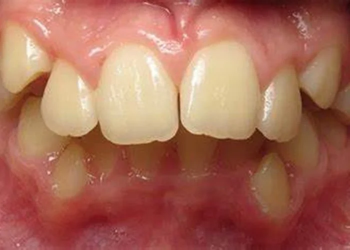 Close-up of a person's teeth showing misalignment and spacing issues.