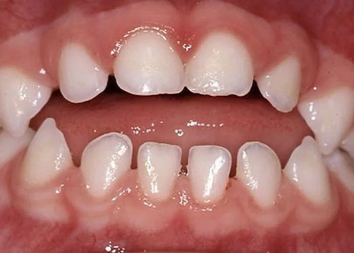 Close-up of a child's mouth showing teeth with gaps and uneven spacing.