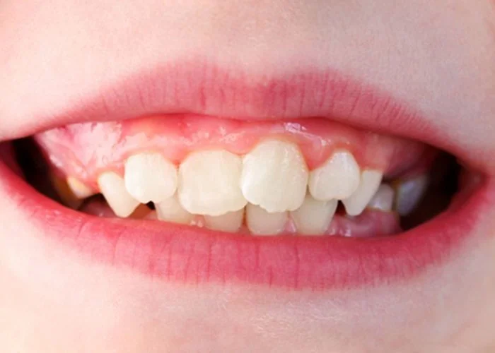Close-up of a child's smile showing their front teeth, with some teeth missing or crooked.