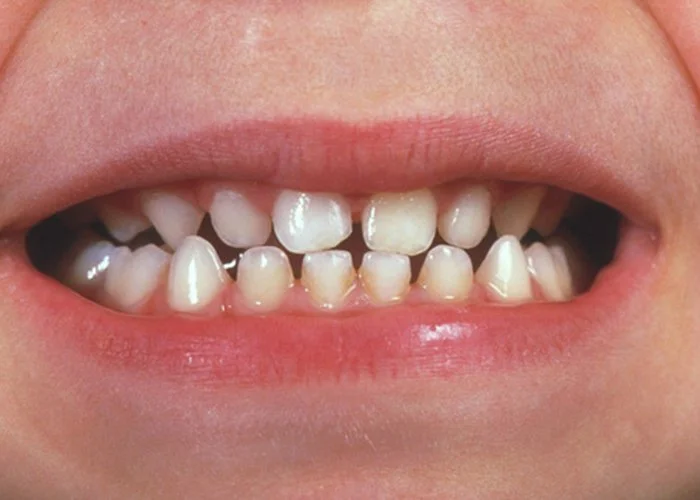 Close-up of a child's mouth with misaligned and irregularly spaced teeth.